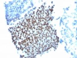 Immunohistochemistry-Paraffin: p21/CIP1/CDKN1A Antibody (WA-1 (HJ21)) [NBP2-29463] - Formalin-fixed, paraffin-embedded human bladder carcinoma stained with p21 Monoclonal Antibody (WA-1).