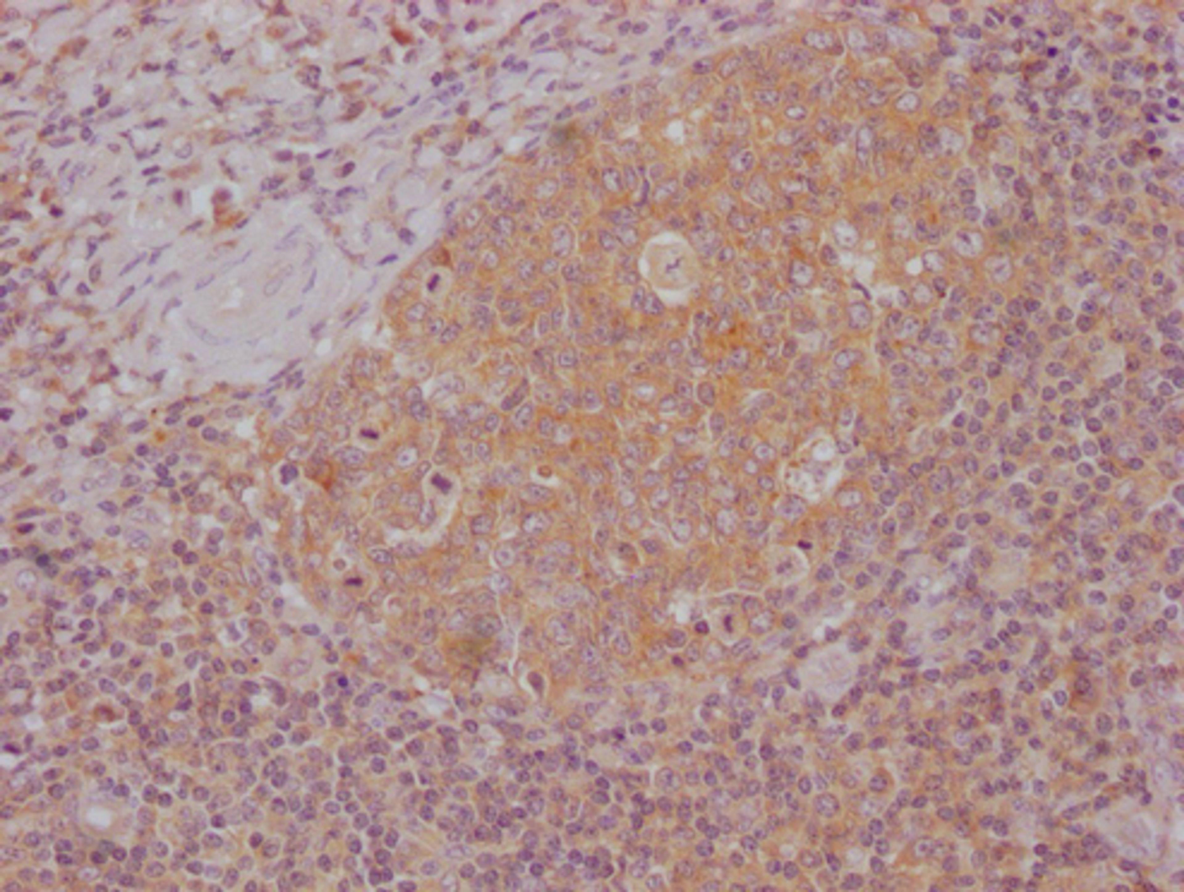 IHC image of CSB-MA996413 diluted at 1:100 and staining in paraffin-embedded human tonsil tissue performed on a Leica BondTM system. After dewaxing and hydration, antigen retrieval was mediated by high pressure in a citrate buffer (pH 6.0). Section was blocked with 10% normal goat serum 30min at RT. Then primary antibody (1% BSA) was incubated at 4°C overnight. The primary is detected by a Goat anti-mouse IgG polymer labeled by HRP and visualized using 0.05% DAB.