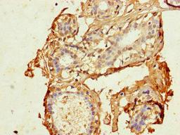 Immunohistochemistry of paraffin-embedded human breast cancer using CSB-PA005075LA01HU at dilution of 1:100