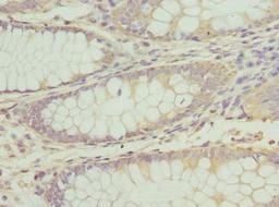 Immunohistochemistry of paraffin-embedded human colon cancer using CSB-PA002336DSR1HU at dilution of 1:100
