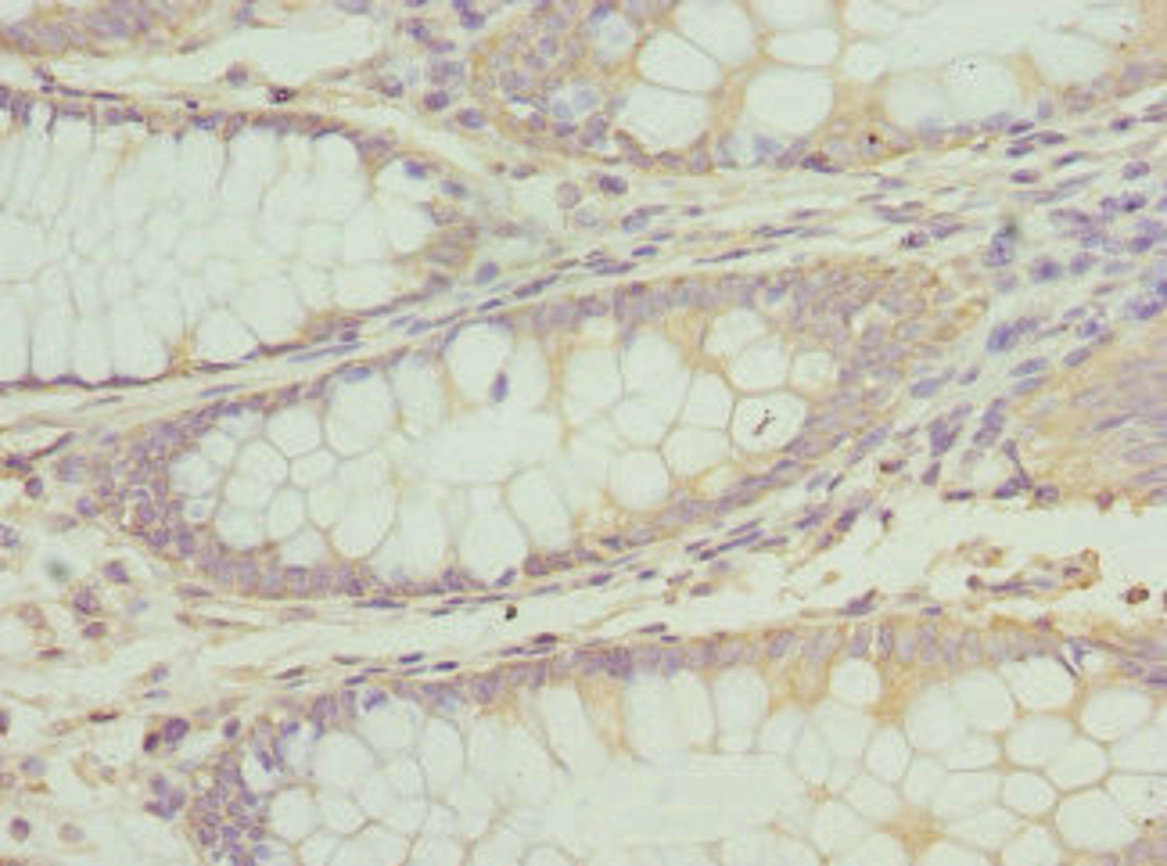 Immunohistochemistry of paraffin-embedded human colon cancer using CSB-PA002336DSR1HU at dilution of 1:100