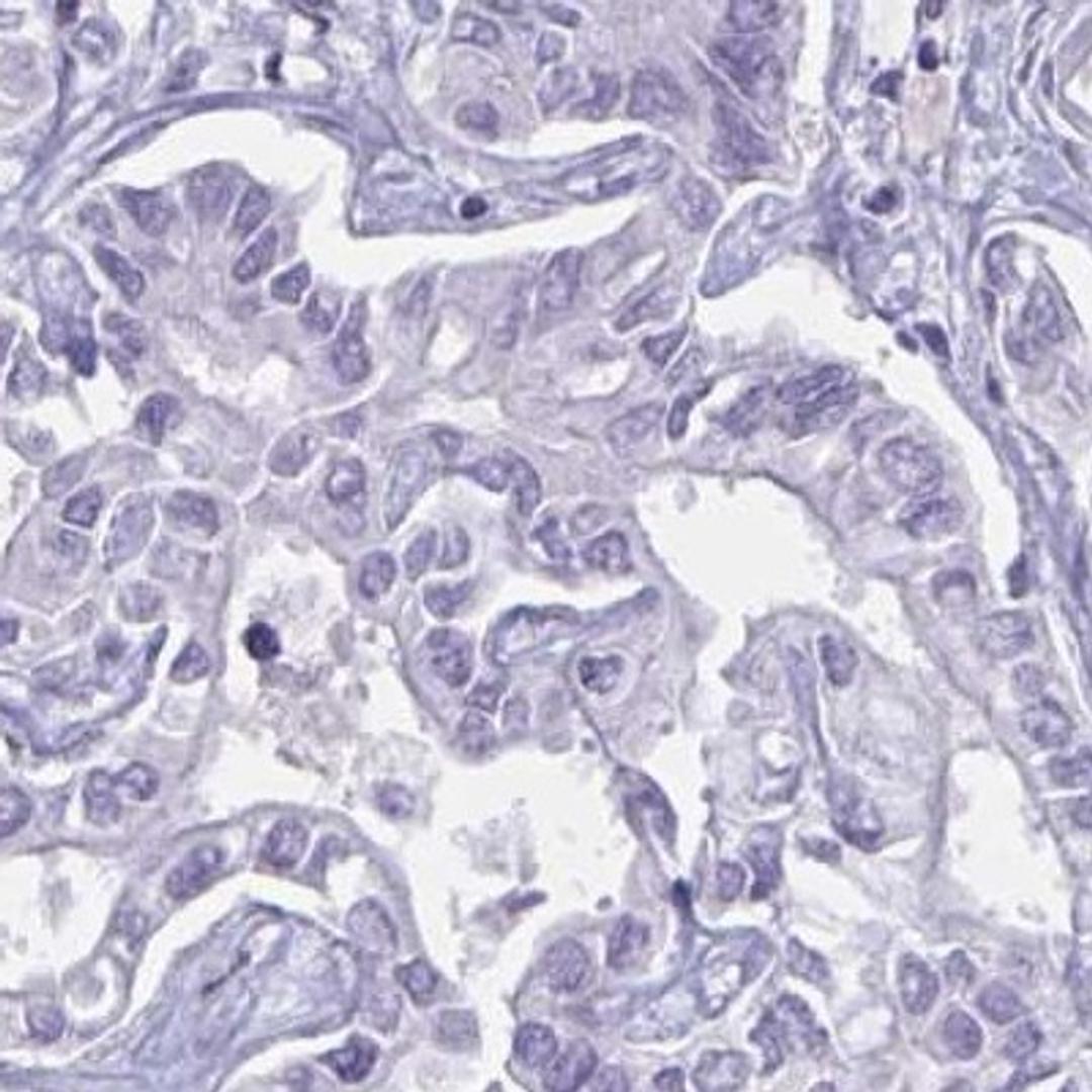 Immunohistochemistry: BBS10 Antibody [NBP2-32399] - liver cancer