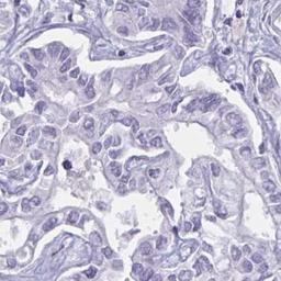 Immunohistochemistry: BBS10 Antibody [NBP2-32399] - liver cancer