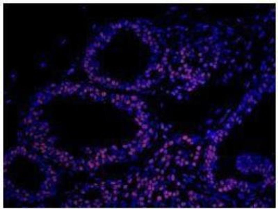 Immunocytochemistry: Matrin 3 Antibody [NB100-1761] - Section of human breast carcinoma.