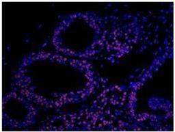 Immunocytochemistry: Matrin 3 Antibody [NB100-1761] - Section of human breast carcinoma.