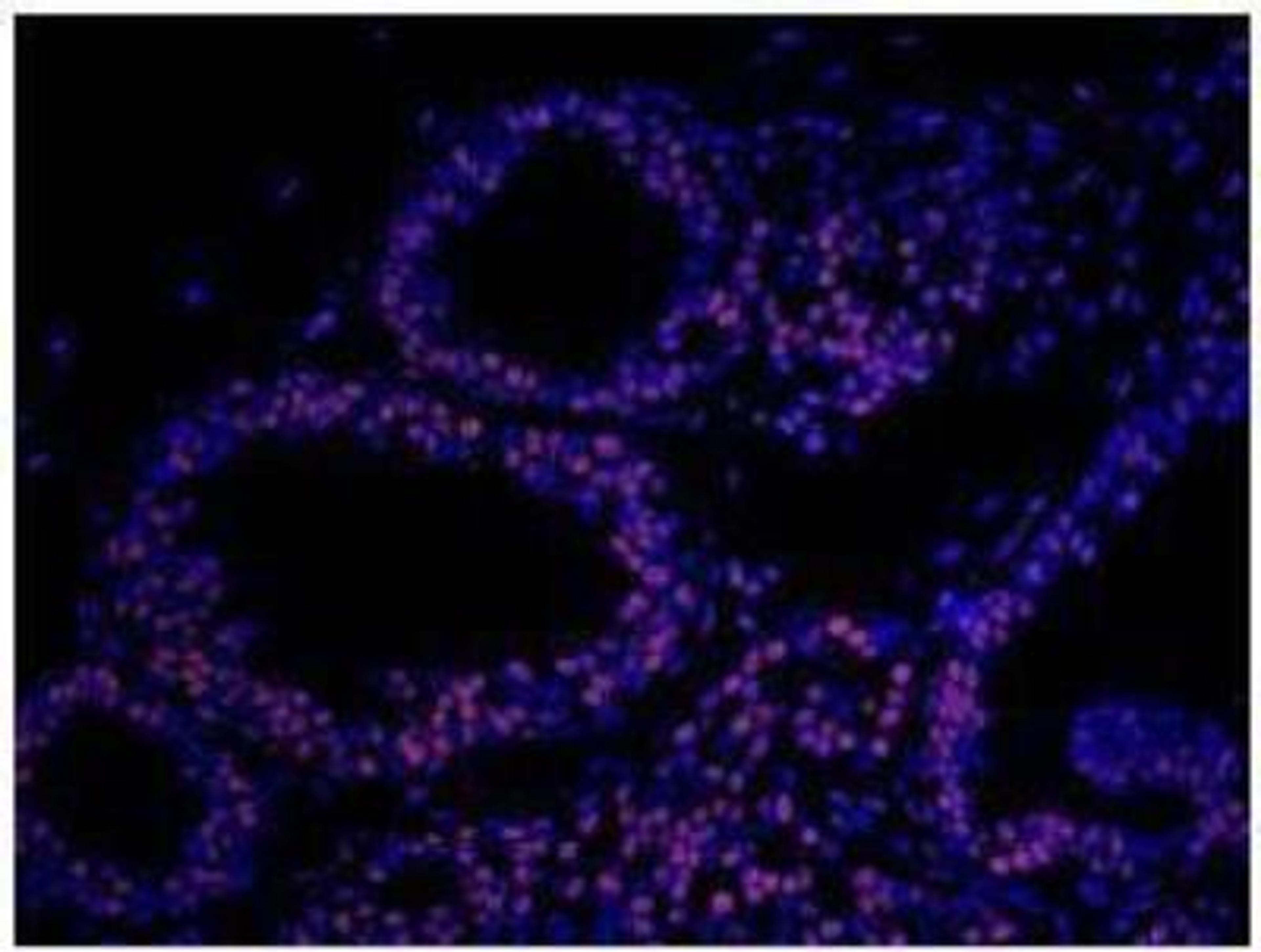 Immunocytochemistry: Matrin 3 Antibody [NB100-1761] - Section of human breast carcinoma.