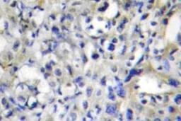 Immunohistochemistry-Paraffin: Prothrombin Antibody [NBP1-00992] - Immunohistochemistry (IHC) analyzes of  Prothrombin (G724) antibody in paraffin-embedded human liver carcinoma tissue