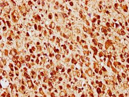 IHC image of CSB-PA010379OA140nforHU diluted at 1:14 and staining in paraffin-embedded human glioma cancer performed on a Leica BondTM system. After dewaxing and hydration, antigen retrieval was mediated by high pressure in a citrate buffer (pH 6.0). Section was blocked with 10% normal goat serum 30min at RT. Then primary antibody (1% BSA) was incubated at 4°C overnight. The primary is detected by a biotinylated secondary antibody and visualized using an HRP conjugated SP system.