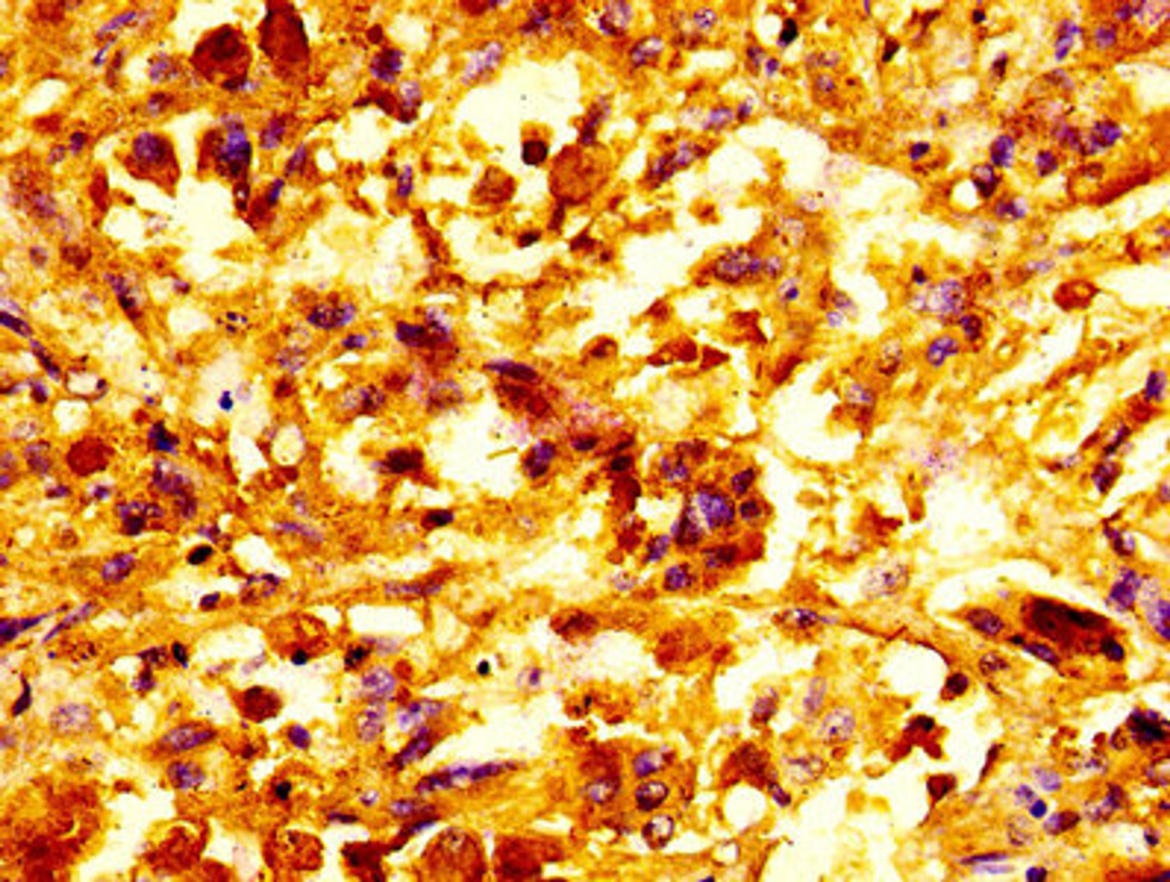 IHC image of CSB-PA06997A0Rb diluted at 1:100 and staining in paraffin-embedded human melanoma performed on a Leica BondTM system. After dewaxing and hydration, antigen retrieval was mediated by high pressure in a citrate buffer (pH 6.0). Section was blocked with 10% normal goat serum 30min at RT. Then primary antibody (1% BSA) was incubated at 4&deg;C overnight. The primary is detected by a biotinylated secondary antibody and visualized using an HRP conjugated SP system.