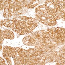 Detection of human YB1 by immunohistochemistry.