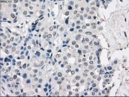 Immunohistochemistry-Paraffin: Protein Kinase A regulatory subunit I alpha Antibody (6C7) [NBP1-47935] - Staining of paraffin-embedded Adenocarcinoma of breast tissue using anti-Protein Kinase A regulatory subunit I alpha mouse monoclonal antibody.