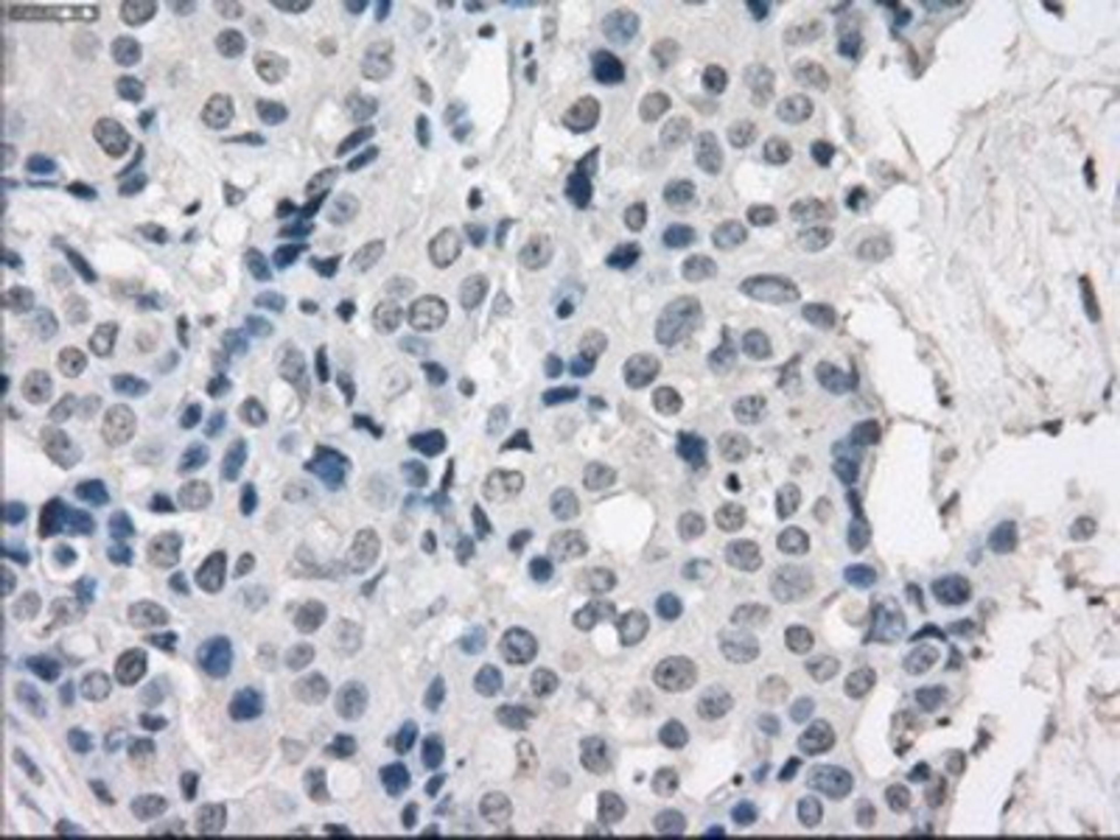 Immunohistochemistry-Paraffin: Protein Kinase A regulatory subunit I alpha Antibody (6C7) [NBP1-47935] - Staining of paraffin-embedded Adenocarcinoma of breast tissue using anti-Protein Kinase A regulatory subunit I alpha mouse monoclonal antibody.