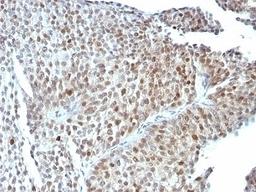 Formalin-fixed, paraffin-embedded human bladder carcinoma stained with anti-p53 antibody (SPM589).