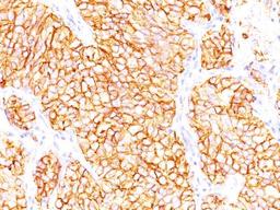 Immunohistochemistry-Paraffin: Renal Cell Carcinoma (gp200) Antibody (66.4.C2 (PN-15)) [NBP2-15199] - Formalin-paraffin human renal cell carcinoma stained with RCC Ab (66.4.C2).  Note cytoplasmic & cell surface staining of tumor cells.