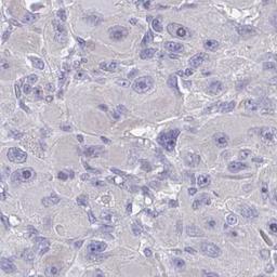 Immunohistochemistry: FBXO47 Antibody [NBP2-31679] - liver cancer