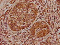 IHC image of CSB-PA007598LA01HU diluted at 1:500 and staining in paraffin-embedded human pancreatic cancer performed on a Leica BondTM system. After dewaxing and hydration, antigen retrieval was mediated by high pressure in a citrate buffer (pH 6.0). Section was blocked with 10% normal goat serum 30min at RT. Then primary antibody (1% BSA) was incubated at 4°C overnight. The primary is detected by a biotinylated secondary antibody and visualized using an HRP conjugated SP system.