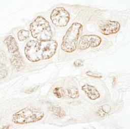 Immunohistochemistry-Paraffin: SET1B Antibody [NBP1-28684] - Human ovarian carcinoma.   Antibody used  at a dilution of 1:1,000.