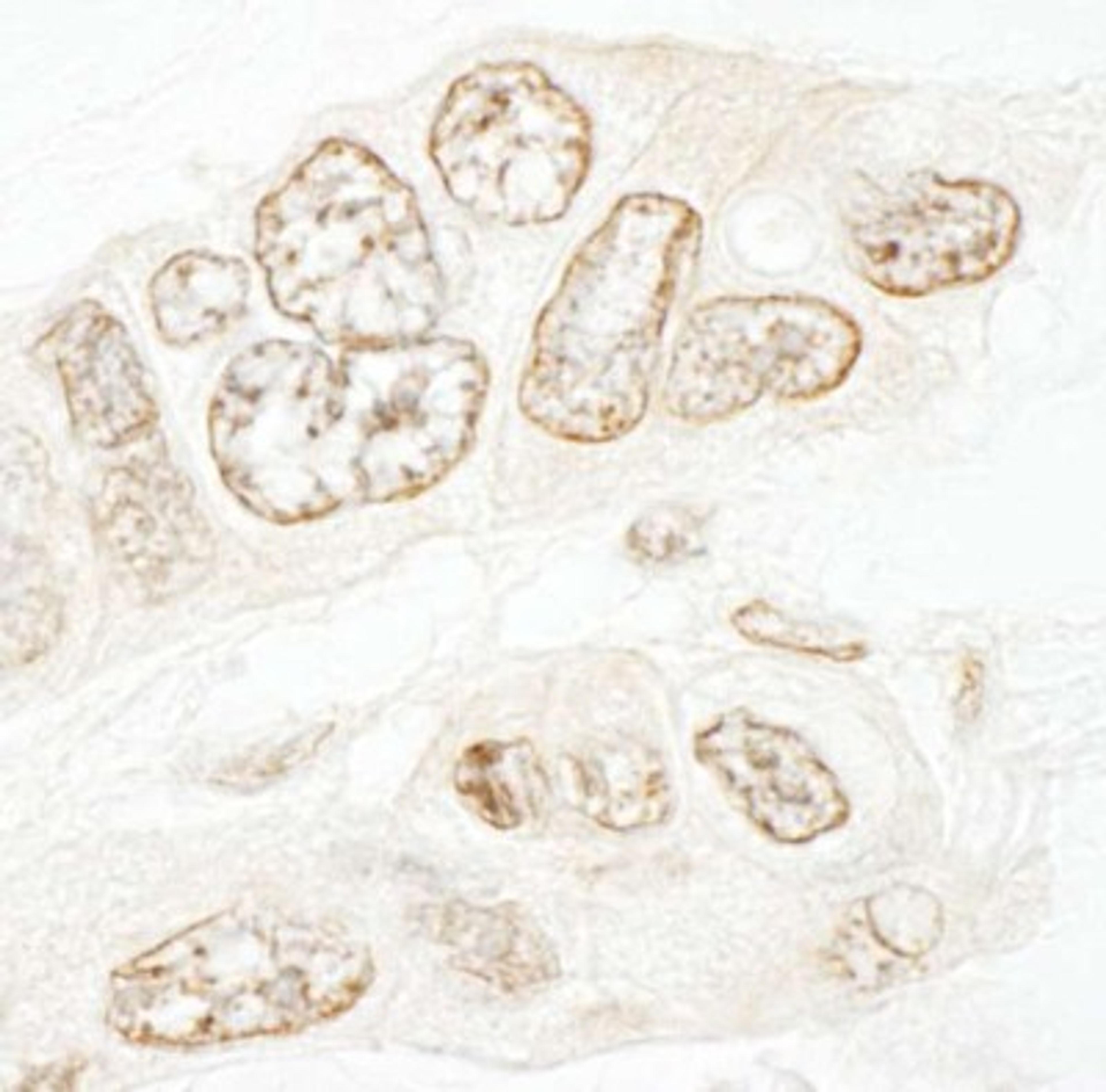 Immunohistochemistry-Paraffin: SET1B Antibody [NBP1-28684] - Human ovarian carcinoma.   Antibody used  at a dilution of 1:1,000.