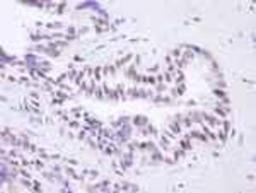 Immunohistochemistry-Paraffin: BRD8 Antibody [NB100-79781] - FFPE section of human prostate adenocarcinoma.  Affinity purified rabbit anti-BRD8 used at a dilution of 1:100.