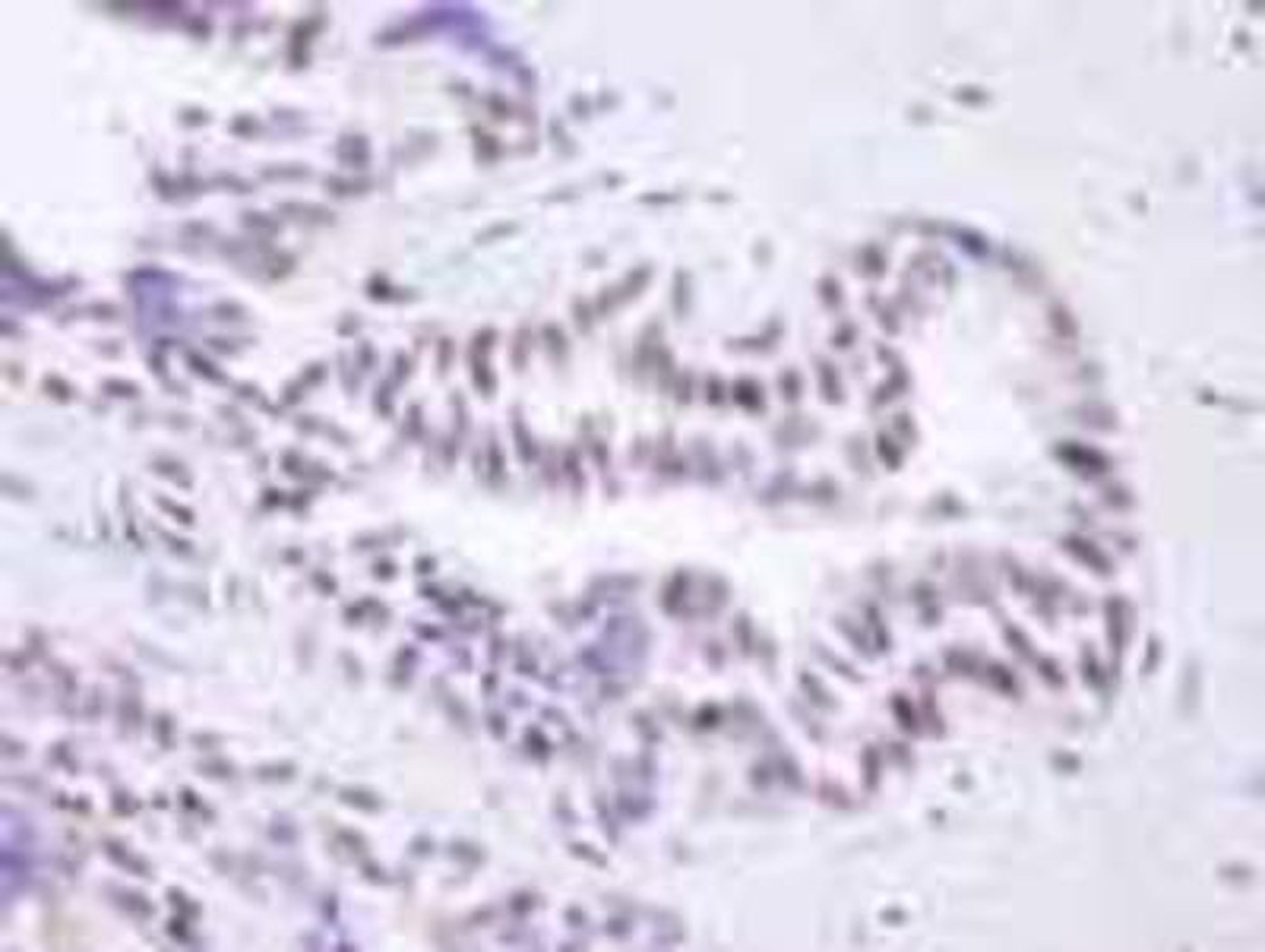 Immunohistochemistry-Paraffin: BRD8 Antibody [NB100-79781] - FFPE section of human prostate adenocarcinoma.  Affinity purified rabbit anti-BRD8 used at a dilution of 1:100.