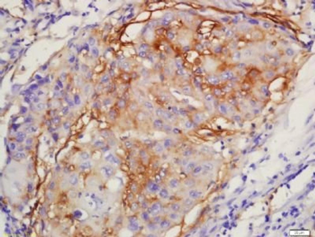 Immunohistochemical staining of human lung cancer tissue using ERK1 (phospho-Thr183-185) antibody.