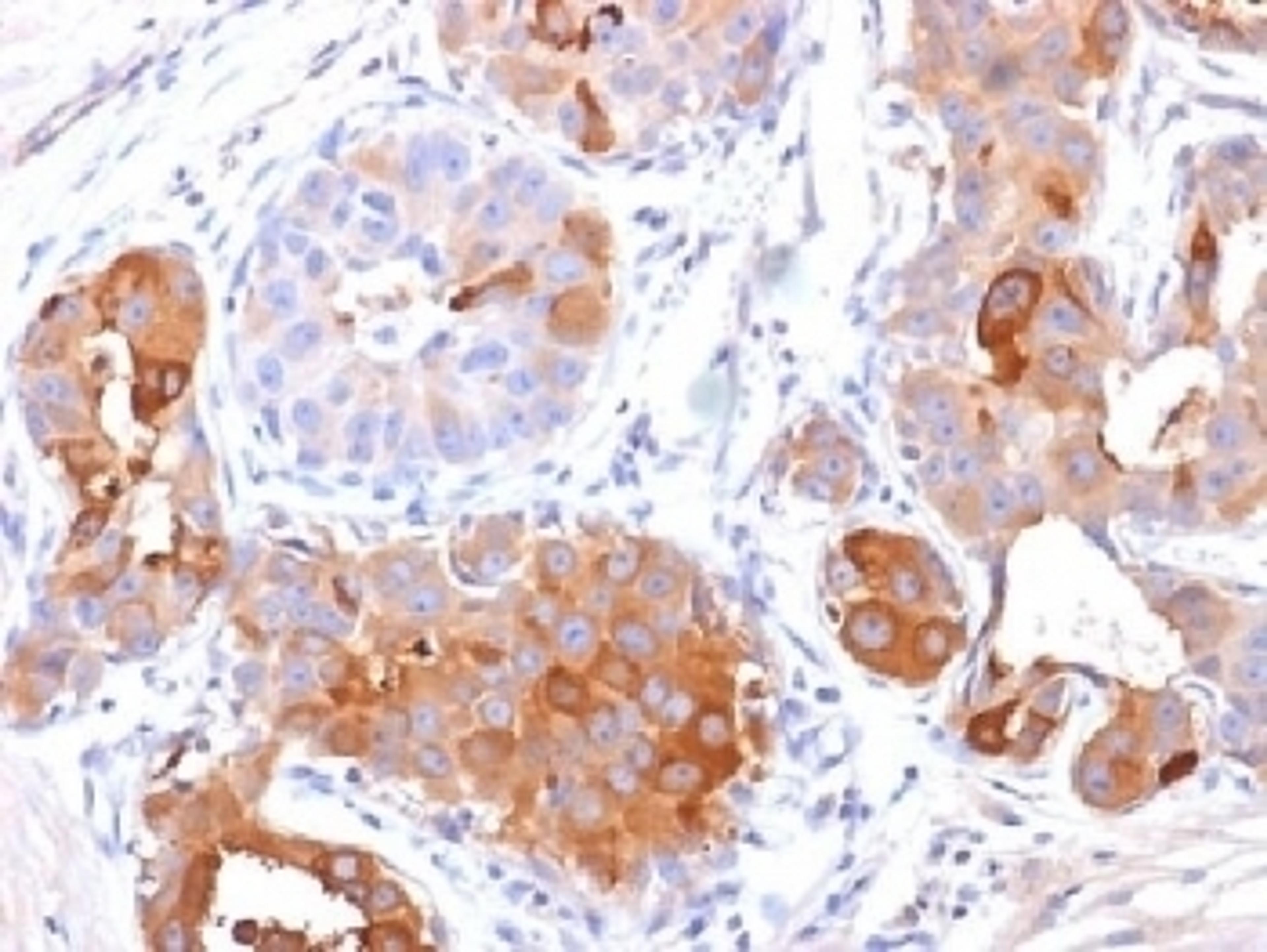 IHC testing of FFPE human breast carcinoma with PIP antibody (clone PIP/1571). Required HIER: boil tissue sections in 10mM Tris with 1mM EDTA, pH 9, for 10-20.