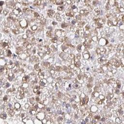 Immunohistochemistry: STARD8 Antibody [NBP2-32567] - liver cancer