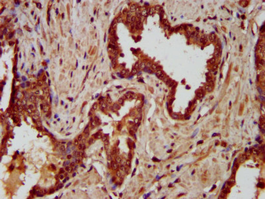 IHC image of CSB-PA848833LA01HU diluted at 1:200 and staining in paraffin-embedded human prostate cancer performed on a Leica BondTM system. After dewaxing and hydration, antigen retrieval was mediated by high pressure in a citrate buffer (pH 6.0). Section was blocked with 10% normal goat serum 30min at RT. Then primary antibody (1% BSA) was incubated at 4°C overnight. The primary is detected by a biotinylated secondary antibody and visualized using an HRP conjugated SP system.