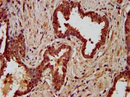 IHC image of CSB-PA848833LA01HU diluted at 1:200 and staining in paraffin-embedded human prostate cancer performed on a Leica BondTM system. After dewaxing and hydration, antigen retrieval was mediated by high pressure in a citrate buffer (pH 6.0). Section was blocked with 10% normal goat serum 30min at RT. Then primary antibody (1% BSA) was incubated at 4°C overnight. The primary is detected by a biotinylated secondary antibody and visualized using an HRP conjugated SP system.