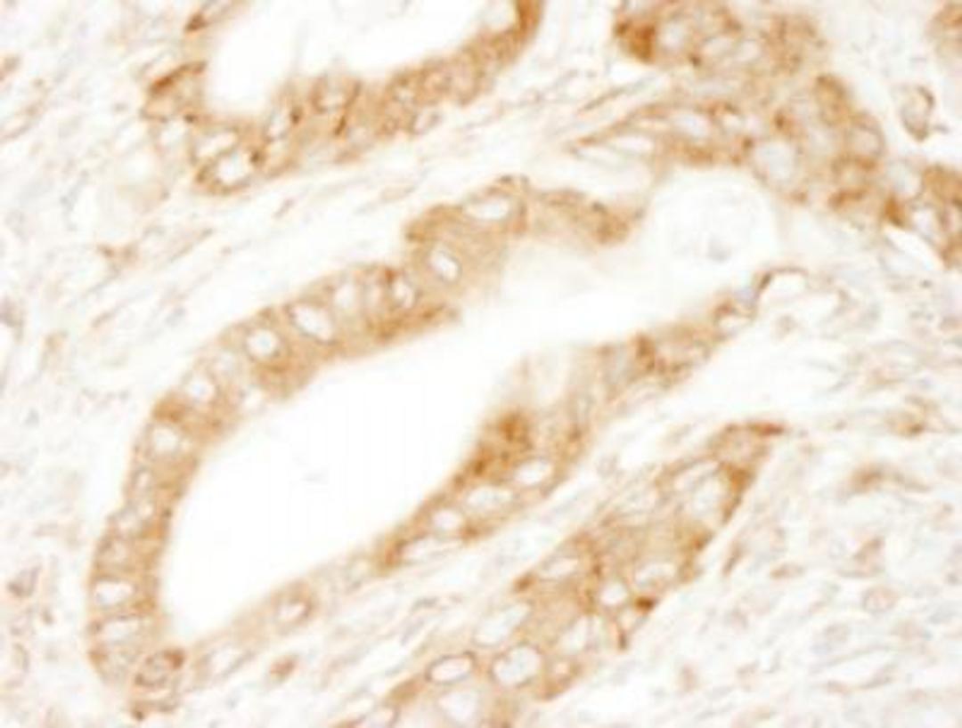 Immunohistochemistry-Paraffin: Ribosomal Protein S6/RPS6 Antibody [NB100-1595] - Human lung carcinoma. Antibody: Affinity purified rabbit anti-RPS6 used at a dilution of 1:200 (1ug/ml).