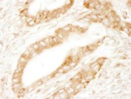 Immunohistochemistry-Paraffin: Ribosomal Protein S6/RPS6 Antibody [NB100-1595] - Human lung carcinoma. Antibody: Affinity purified rabbit anti-RPS6 used at a dilution of 1:200 (1ug/ml).