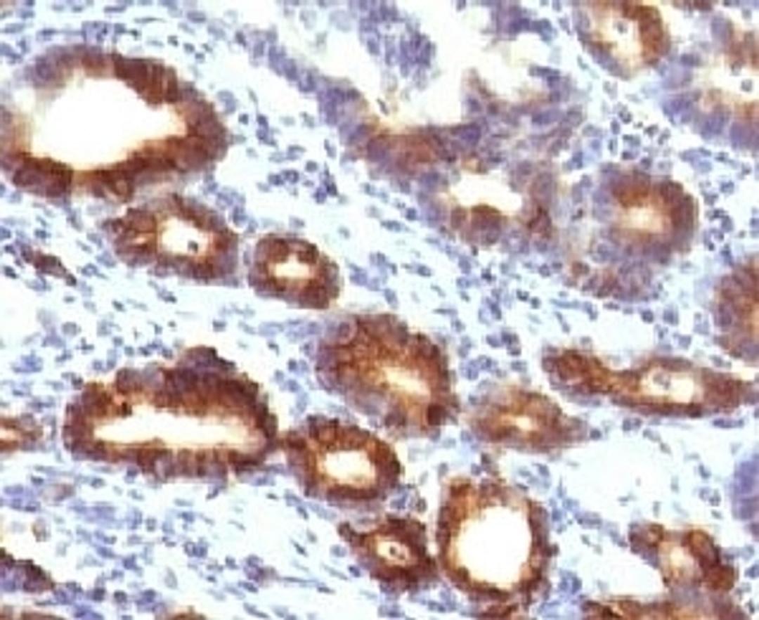 IHC testing of FFPE human gastric carcinoma with Mucin-6 antibody (clone MUCN6-1).