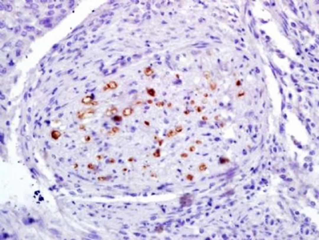 Immunohistochemical analysis of formalin-fixed and paraffin-embedded human laryngocarcinoma tissues using RUNX2 (phospho-Ser451) antibody (dilution at 1:200)