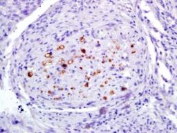 Immunohistochemical analysis of formalin-fixed and paraffin-embedded human laryngocarcinoma tissues using RUNX2 (phospho-Ser451) antibody (dilution at 1:200)