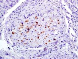 Immunohistochemical analysis of formalin-fixed and paraffin-embedded human laryngocarcinoma tissues using RUNX2 (phospho-Ser451) antibody (dilution at 1:200)