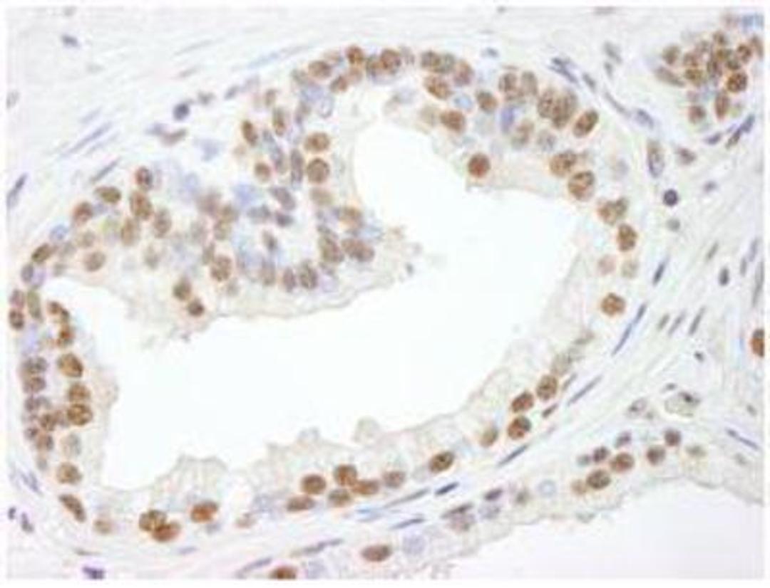 Immunohistochemistry-Paraffin: RBM25 Antibody [NB100-57506] - FFPE section of human  prostate adenocarcinoma.  Affinity purified rabbit anti-RBM25 used at a dilution of 1:500. Detection: DAB staining using Immunohistochemistry Accessory Kit