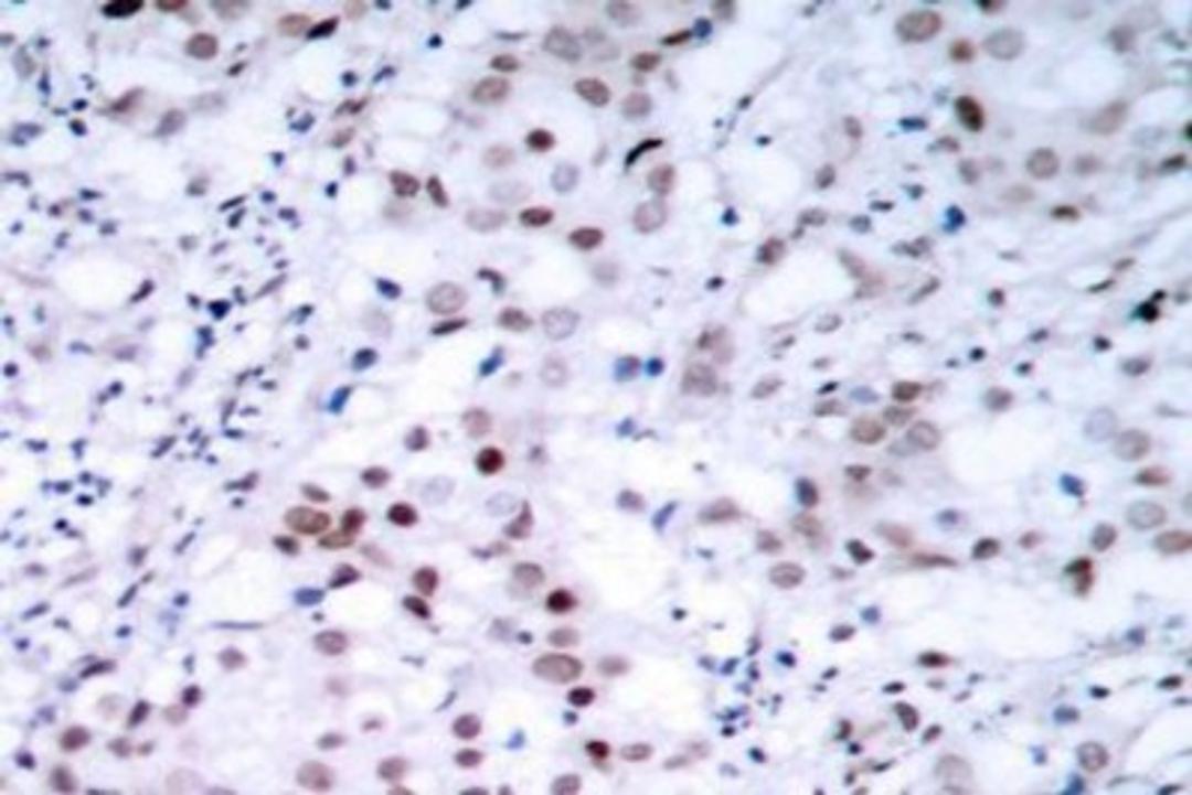 Immunohistochemistry-Paraffin: c-jun [Ser63] Antibody [NB100-92504] - Paraffin-embedded human breast carcinoma tissue.