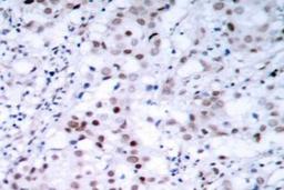 Immunohistochemistry-Paraffin: c-jun [Ser63] Antibody [NB100-92504] - Paraffin-embedded human breast carcinoma tissue.