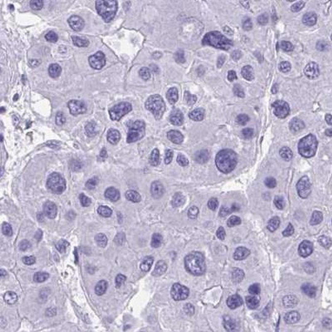 Immunohistochemistry: TTDN1 Antibody [NBP2-31718] - liver cancer