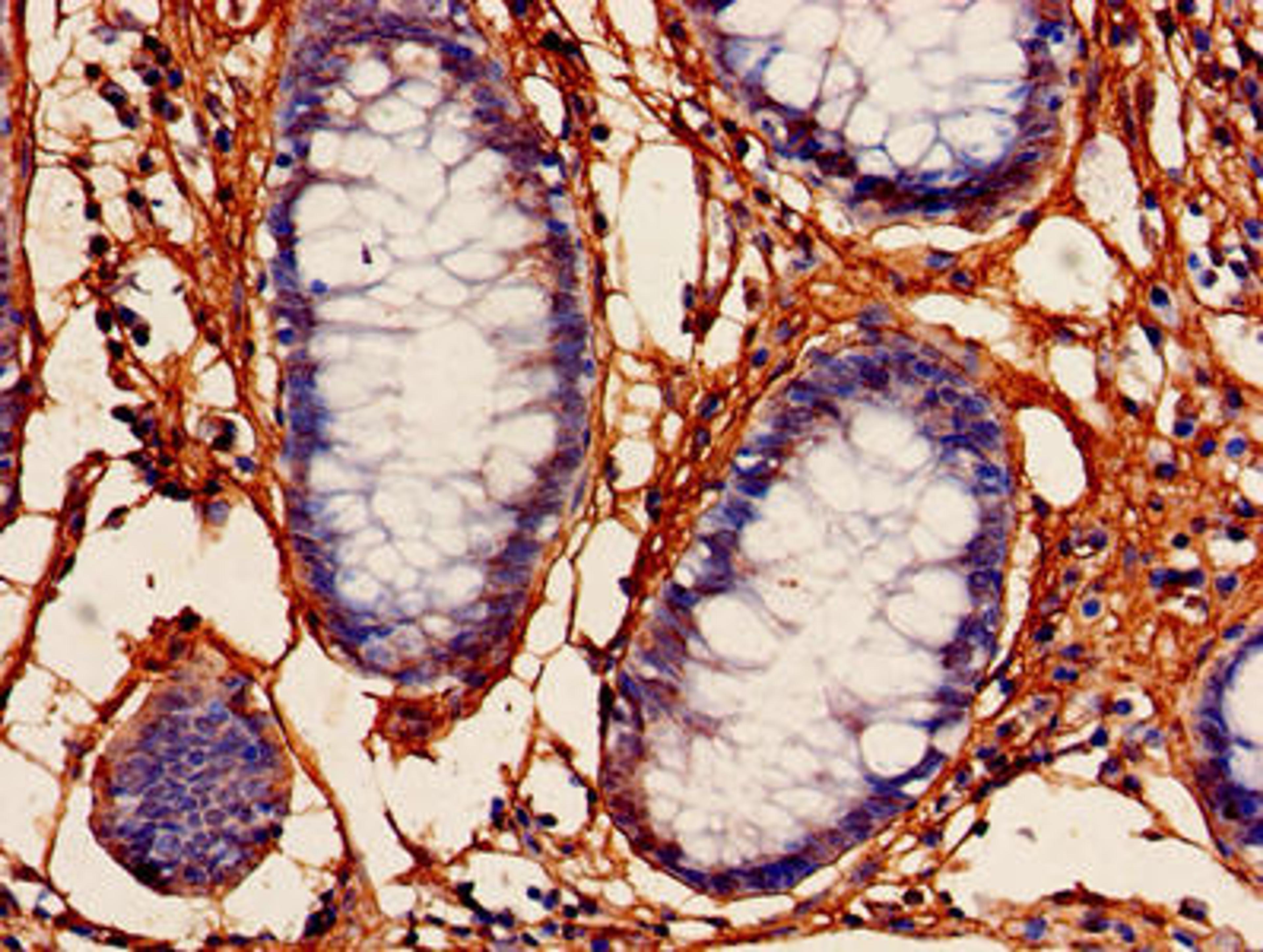 Immunohistochemistry of paraffin-embedded human colon cancer using CSB-PA01415A0Rb at dilution of 1:100