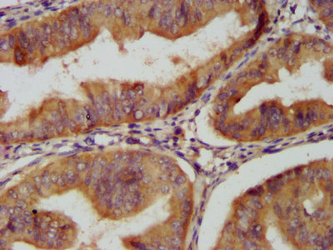 IHC image of CSB-PA06029A0Rb diluted at 1:200 and staining in paraffin-embedded human endometrial cancer performed on a Leica BondTM system. After dewaxing and hydration, antigen retrieval was mediated by high pressure in a citrate buffer (pH 6.0). Section was blocked with 10% normal goat serum 30min at RT. Then primary antibody (1% BSA) was incubated at 4°C overnight. The primary is detected by a biotinylated secondary antibody and visualized using an HRP conjugated SP system.