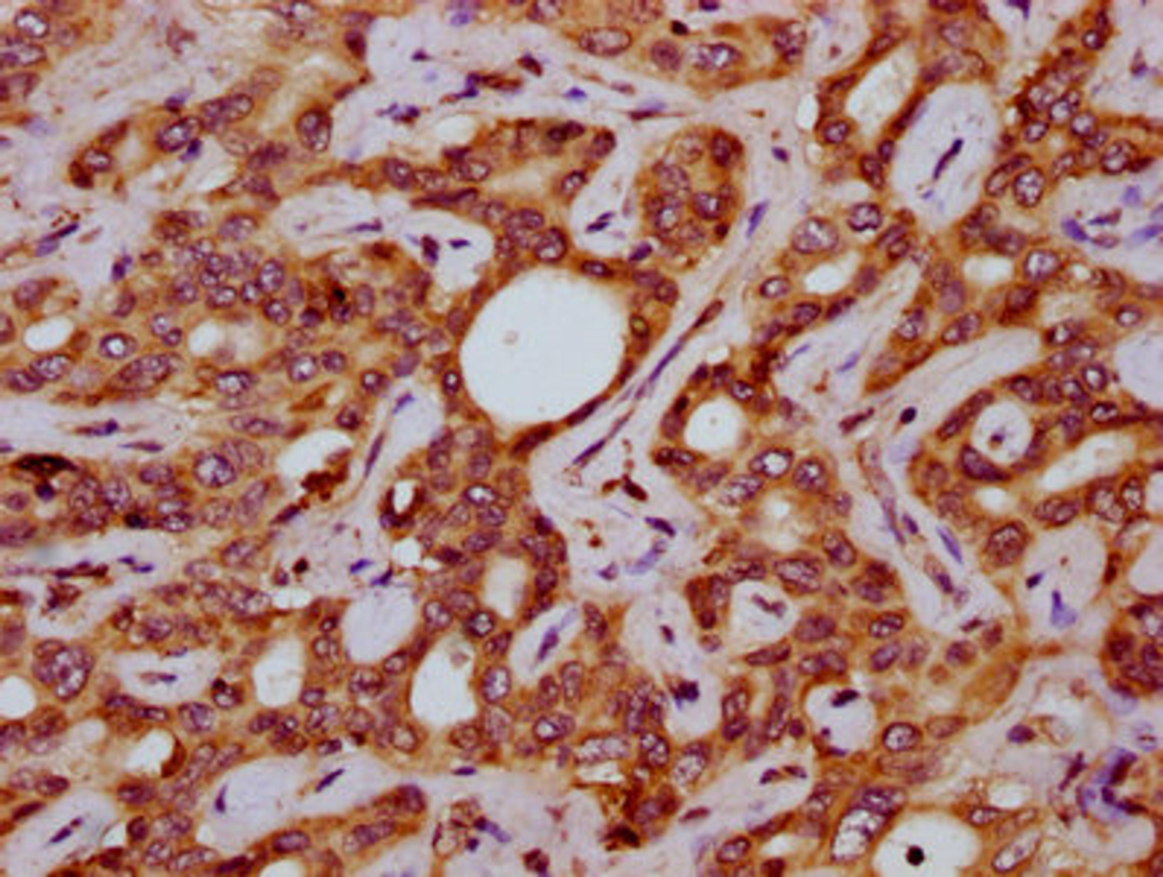 IHC image of CSB-PA843279LA01HU diluted at 1:200 and staining in paraffin-embedded human liver cancer performed on a Leica BondTM system. After dewaxing and hydration, antigen retrieval was mediated by high pressure in a citrate buffer (pH 6.0). Section was blocked with 10% normal goat serum 30min at RT. Then primary antibody (1% BSA) was incubated at 4&deg;C overnight. The primary is detected by a biotinylated secondary antibody and visualized using an HRP conjugated SP system.