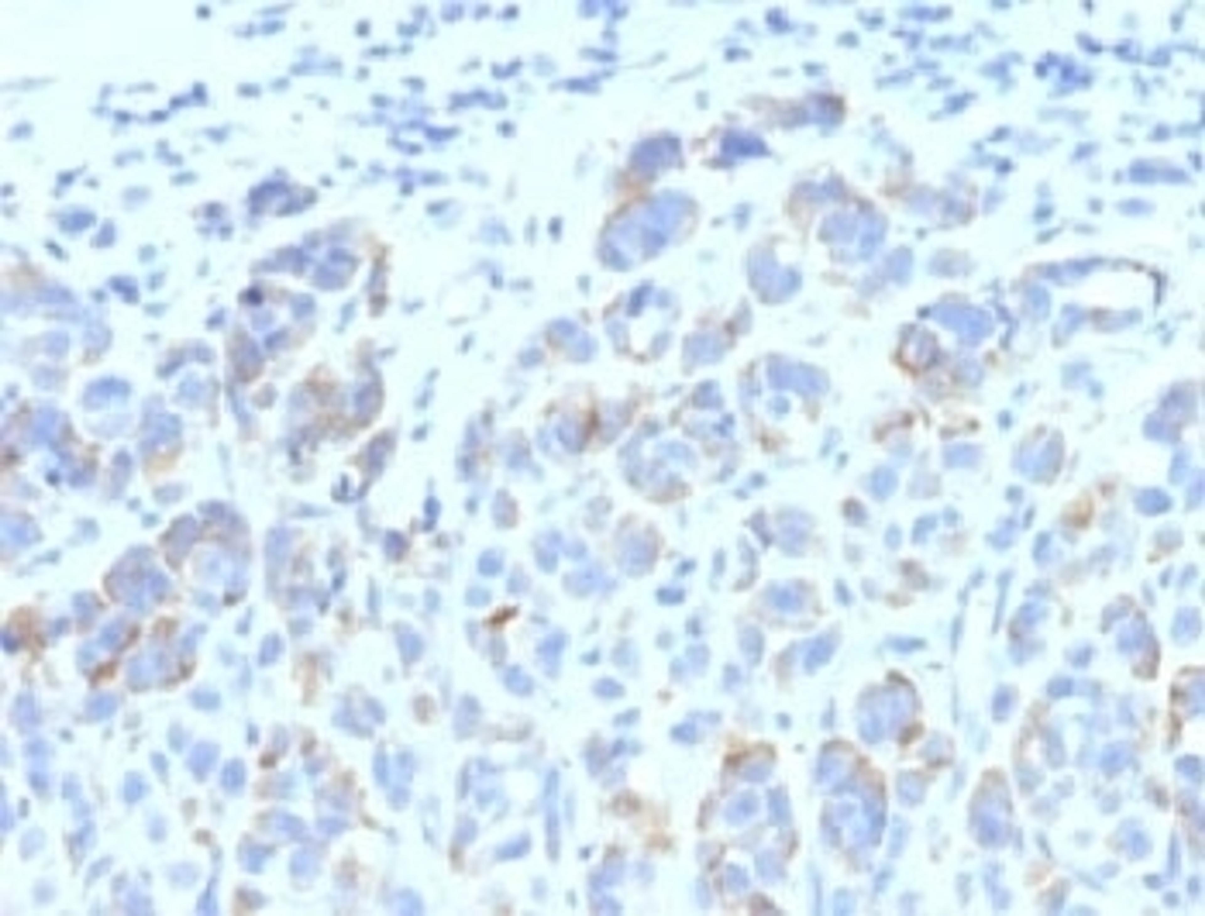 Formalin-fixed, paraffin-embedded human melanoma stained with TRP1 antibody (SPM611)