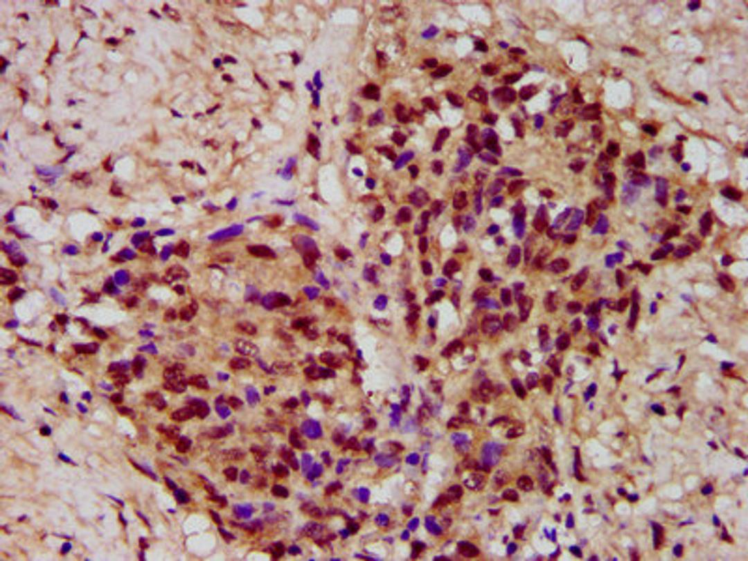 IHC image of CSB-PA883586LA01HU diluted at 1:300 and staining in paraffin-embedded human ovarian cancer performed on a Leica BondTM system. After dewaxing and hydration, antigen retrieval was mediated by high pressure in a citrate buffer (pH 6.0). Section was blocked with 10% normal goat serum 30min at RT. Then primary antibody (1% BSA) was incubated at 4&deg;C overnight. The primary is detected by a biotinylated secondary antibody and visualized using an HRP conjugated SP system.
