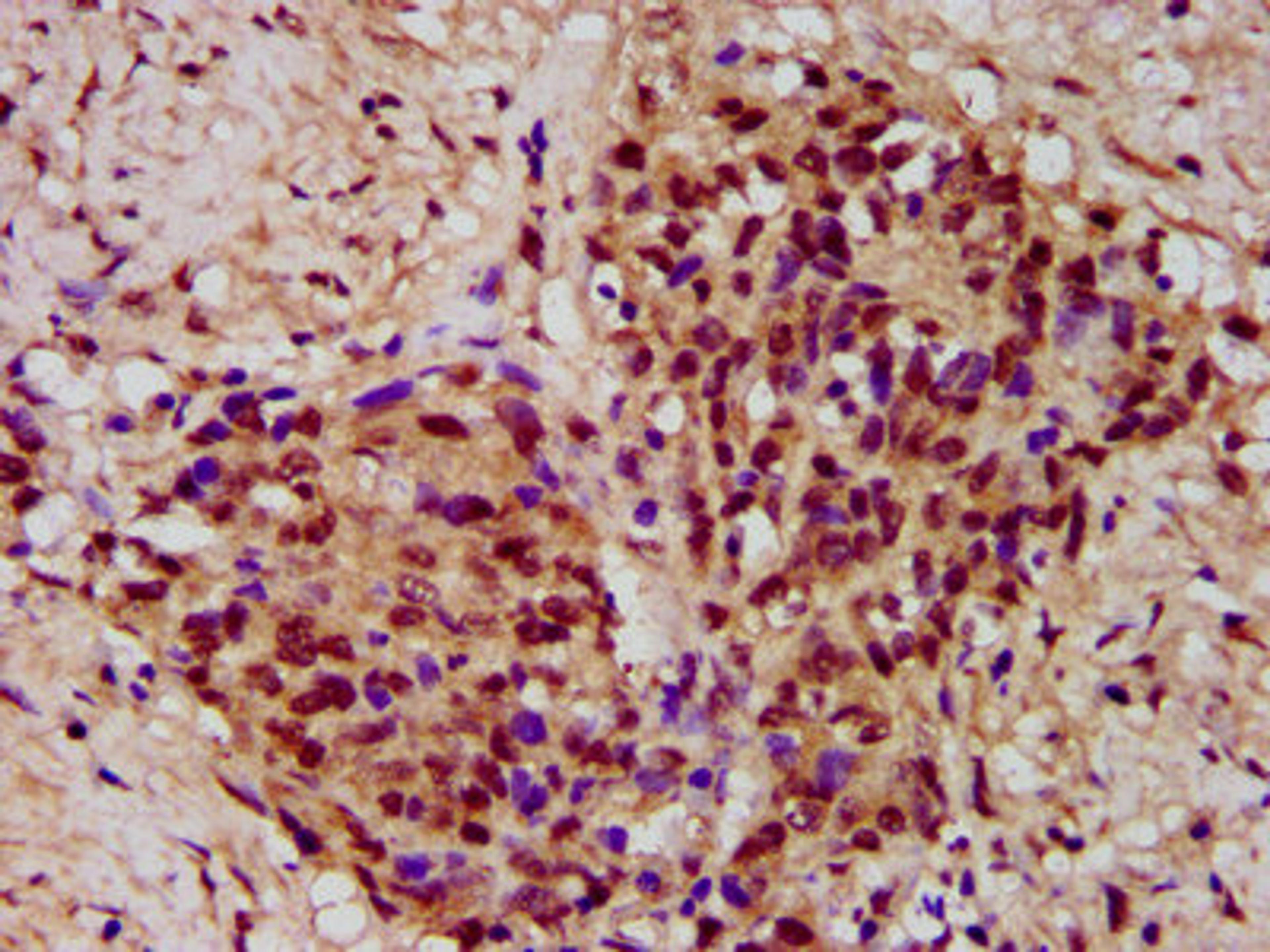 IHC image of CSB-PA883586LA01HU diluted at 1:300 and staining in paraffin-embedded human ovarian cancer performed on a Leica BondTM system. After dewaxing and hydration, antigen retrieval was mediated by high pressure in a citrate buffer (pH 6.0). Section was blocked with 10% normal goat serum 30min at RT. Then primary antibody (1% BSA) was incubated at 4&deg;C overnight. The primary is detected by a biotinylated secondary antibody and visualized using an HRP conjugated SP system.