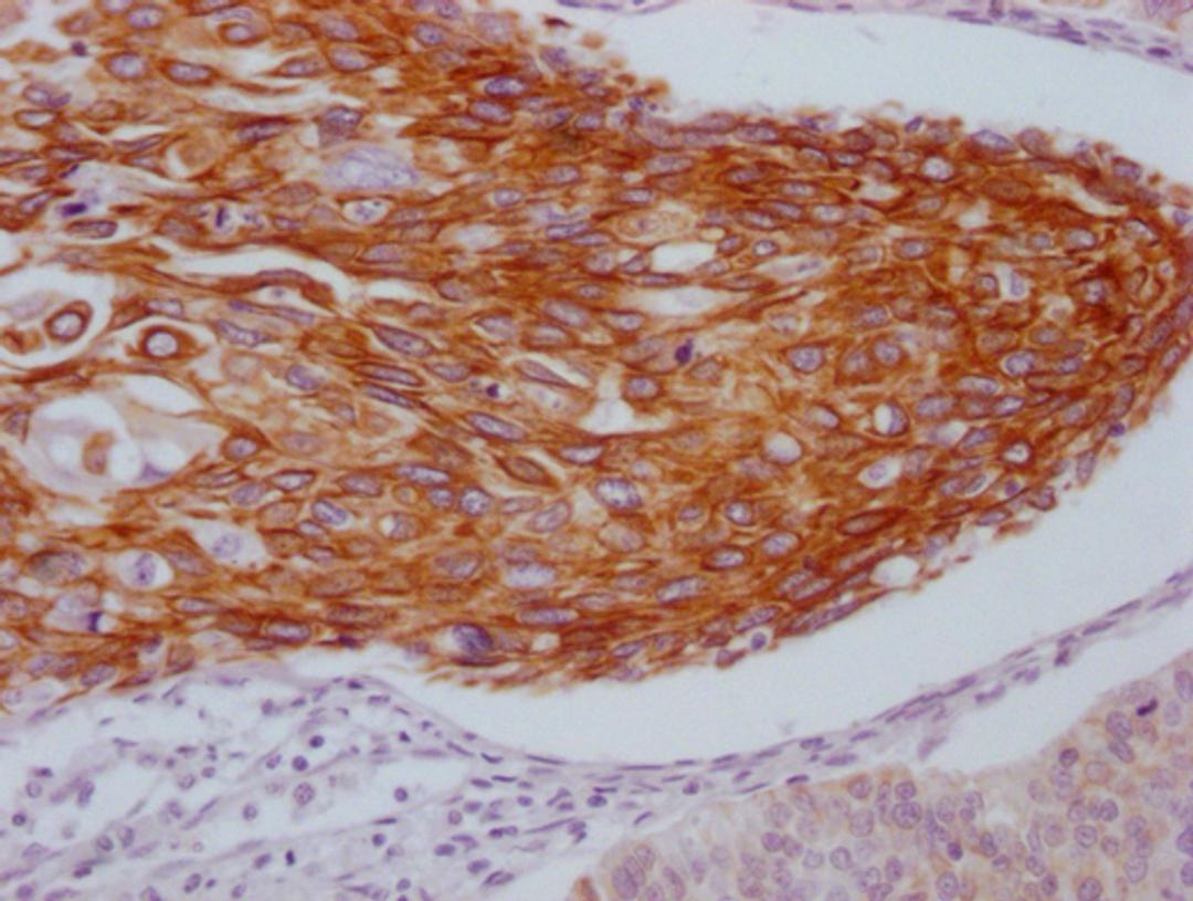 IHC image of CSB-MA550667 diluted at 1:100 and staining in paraffin-embedded human cervical cancer performed on a Leica BondTM system. After dewaxing and hydration, antigen retrieval was mediated by high pressure in a citrate buffer (pH 6.0). Section was blocked with 10% normal goat serum 30min at RT. Then primary antibody (1% BSA) was incubated at 4°C overnight. The primary is detected by a Goat anti-mouse IgG polymer labeled by HRP and visualized using 0.05% DAB.