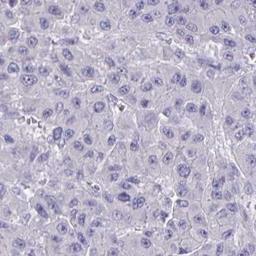 Immunohistochemistry: CCDC105 Antibody [NBP2-32391] - liver cancer