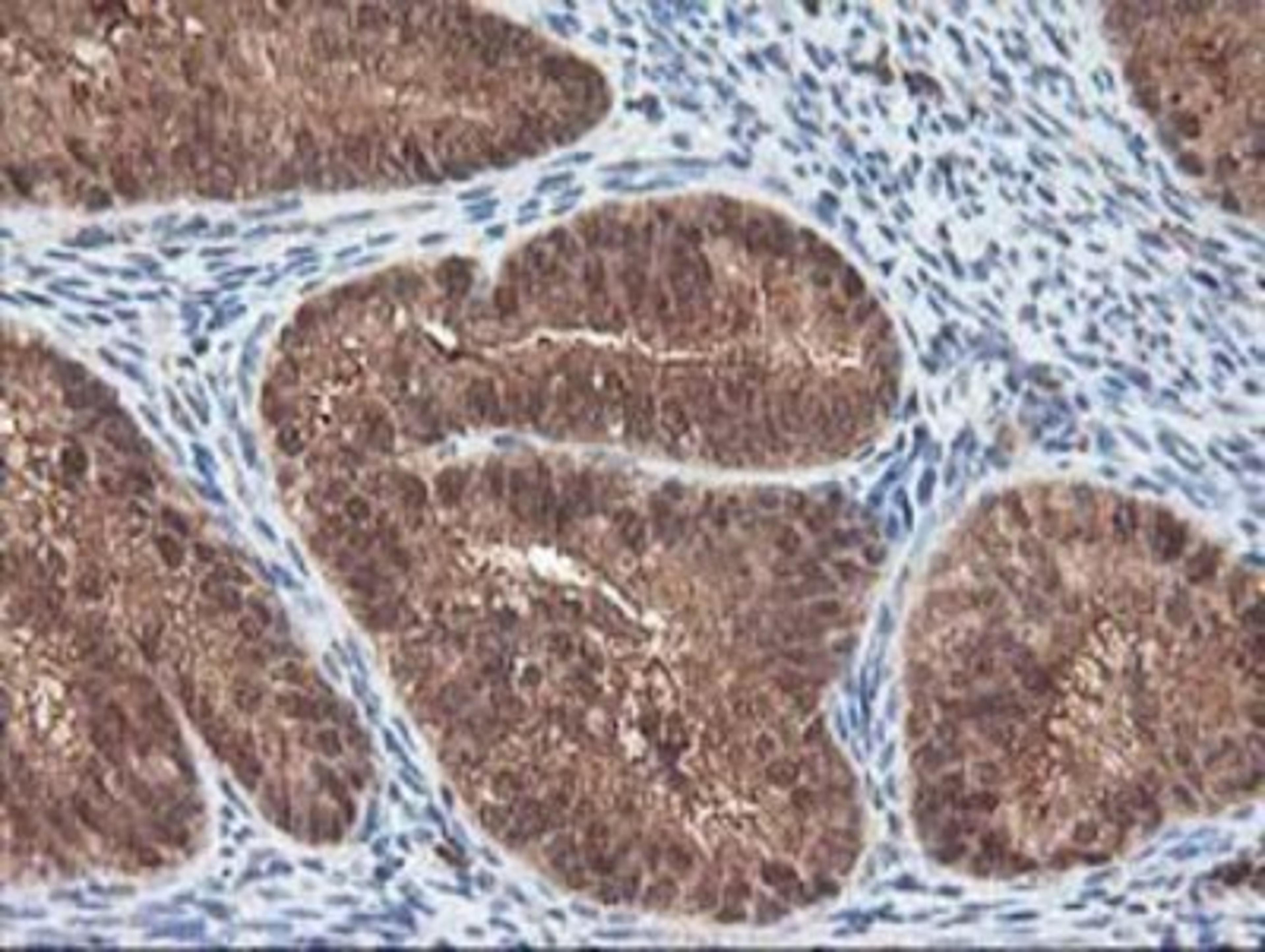 Immunohistochemistry-Paraffin: LCMT1 Antibody (2C9) [NBP2-00923] - Staining of paraffin-embedded Adenocarcinoma of Human endometrium tissue using anti-LCMT1 mouse monoclonal antibody.