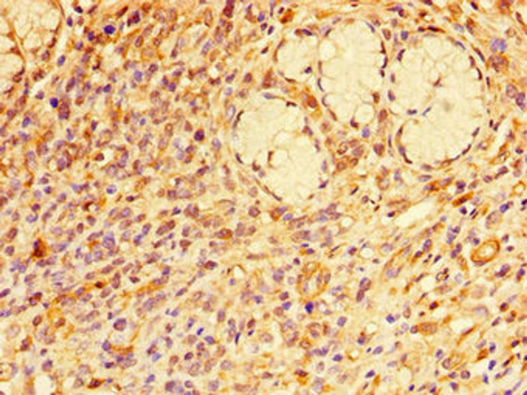 Immunohistochemistry of paraffin-embedded human gastric cancer using CSB-PA019219LA01HU at dilution of 1:100