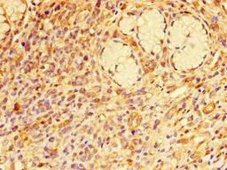 Immunohistochemistry of paraffin-embedded human gastric cancer using CSB-PA019219LA01HU at dilution of 1:100
